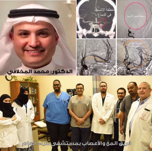إنقاذ حياة مريض بعد إصابته بجلطة دماغية حادة