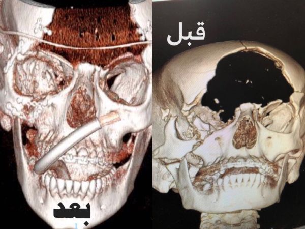 وفاة طالب بالثانوية إثر طلق ناري بالباحة