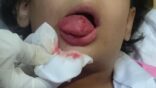 بالصور.. تخليص “لسان” طفلة علق في زمزميتها بجدة