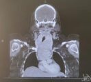 نجاح استئصال ورم من رقبة مريضة بمستشفى الملك عبدالله في بيشة